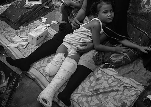 One legged girl bomb victim in Yemen